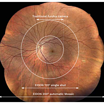 iCare Eidon ultra-widefield module